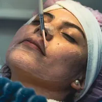 Peeling Facial Profesional